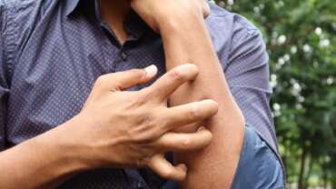 Drug Allergies & Penicillin Exposed – Symptoms, Causes, Diagnosis & Treatment