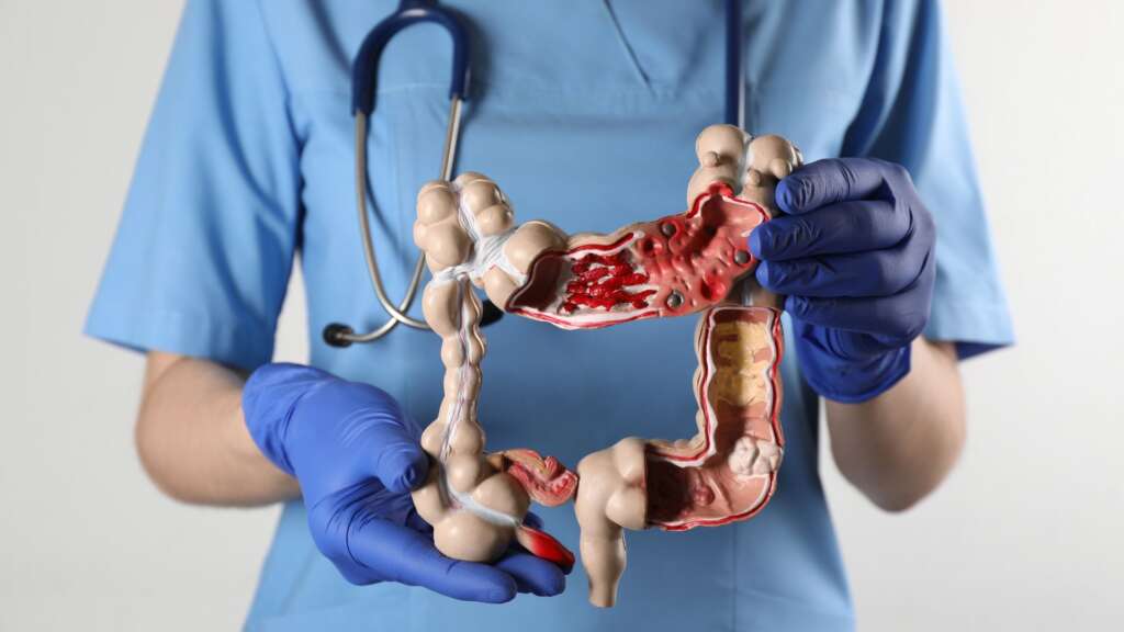 Colon Cancer – What do you need to know?
