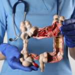 Colon Cancer – What do you need to know?