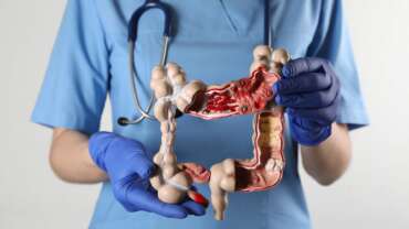 Colon Cancer – What do you need to know?