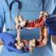 A doctor's illustration colorectal cancer in human colon