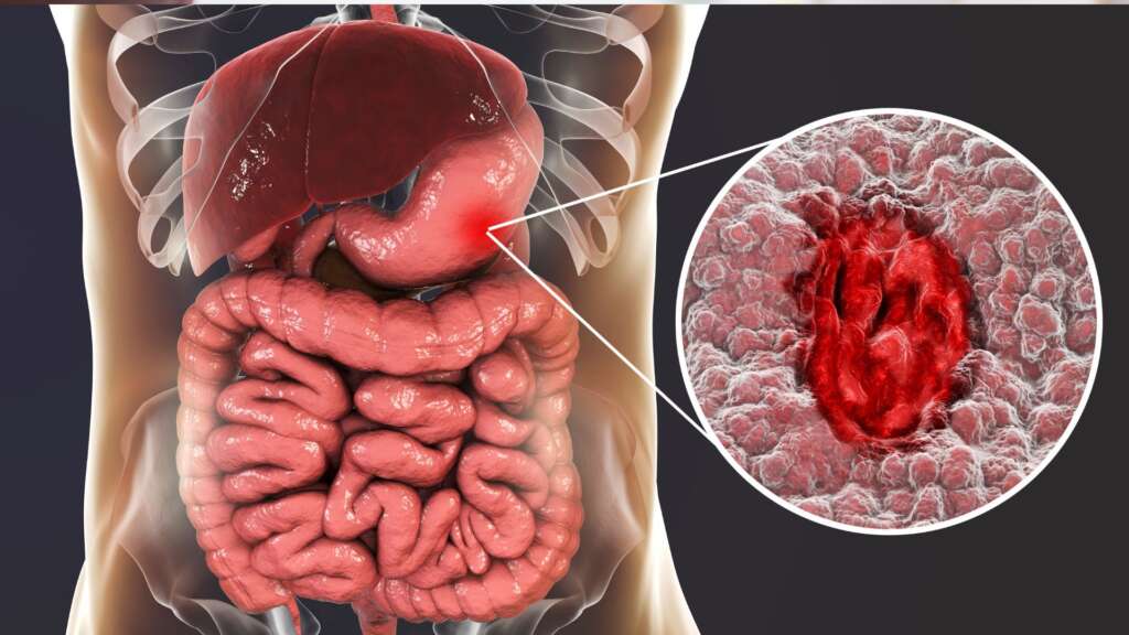 UC Uncovered – Symptoms, Causes, and Top Treatment Solutions for Ulcerative Colitis