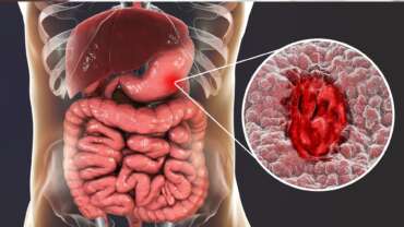 UC Uncovered – Symptoms, Causes, and Top Treatment Solutions for Ulcerative Colitis