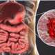 Gastric ulcer mucosa of stomach with ulcer and anatomy of human digestive system 3d illustration representing ulcerative colitis