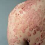 Understanding Psoriasis – Causes, Symptoms, and Effective Treatments