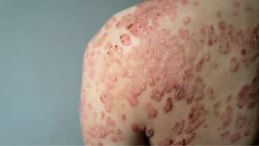 Understanding Psoriasis – Causes, Symptoms, and Effective Treatments