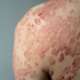 A large red, inflamed, flaky rash on the body affected by psoriasis