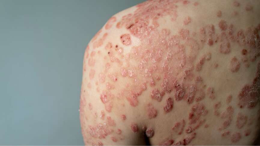 A large red, inflamed, flaky rash on the body affected by psoriasis