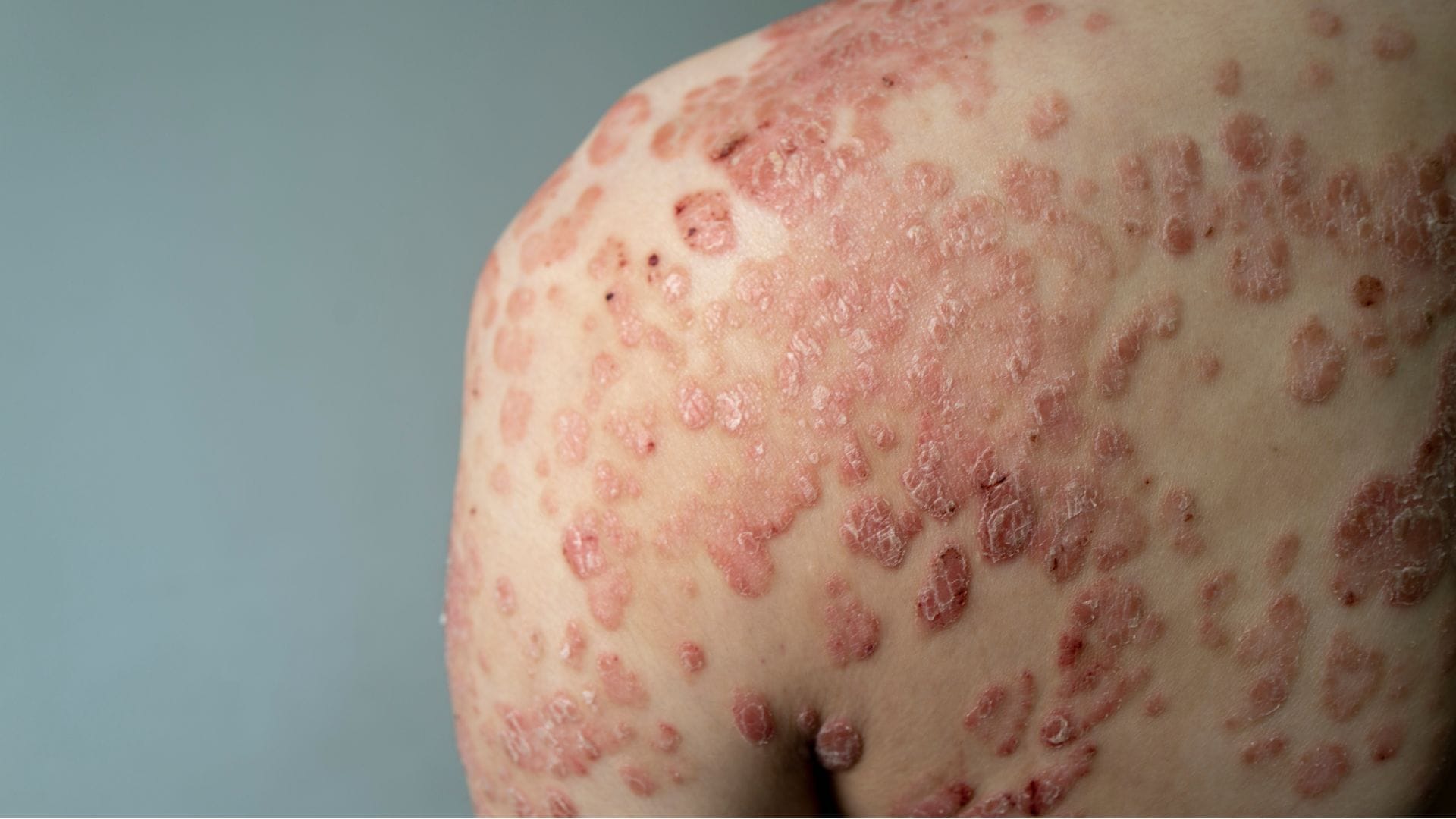 A large red, inflamed, flaky rash on the body affected by psoriasis