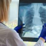 Pulmonary Embolism – Risk Factors, Symptoms, Diagnosis and Treatment