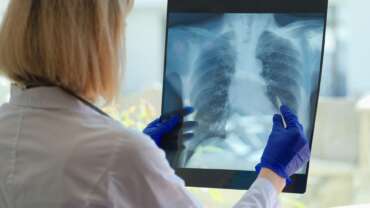 Pulmonary Embolism – Risk Factors, Symptoms, Diagnosis and Treatment
