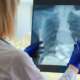 female doctor analyzing lung x-ray image of pulmonary embolism patient