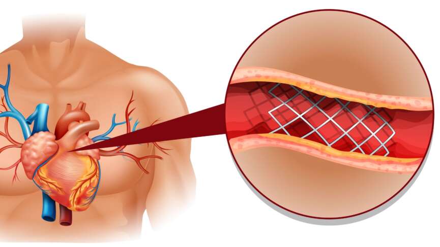 The heart disease diagram in human representing aortic stenosis, is a serious heart condition where the aortic valve narrows, restricting blood flow from the left ventricle to the rest of the body