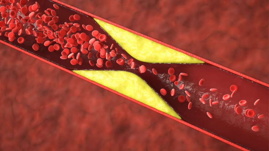 Heart Health – Understanding and Managing Coronary Artery Disease