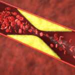 Heart Health – Understanding and Managing Coronary Artery Disease