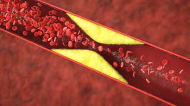 Heart Health – Understanding and Managing Coronary Artery Disease