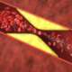 3d illustration of a blocked coronary artery