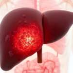 Liver Cirrhosis – Causes, Diagnosis and Treatment