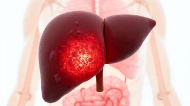 Liver Cirrhosis – Causes, Diagnosis and Treatment
