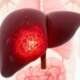 A liver organ with fatty liver state 3d rendering representing liver cirrhosis, is the late-stage, irreversible scarring (fibrosis) of the liver caused by long-term chronic liver diseases, such as hepatitis or alcohol abuse