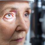 Cataracts – Uncover The Causes, Symptoms, And Modern Cataract Surgery