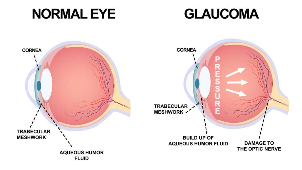 Glaucoma – Symptoms, Types, Treatment, and Surgery