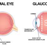 Glaucoma – Symptoms, Types, Treatment, and Surgery