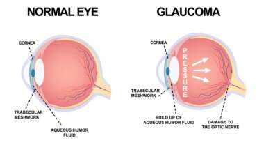 Glaucoma – Eye Drops Side Effects, Symptoms, Types, Treatment, and Surgery