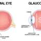 Glaucoma eye drops side effects and optic nerve damage illustration