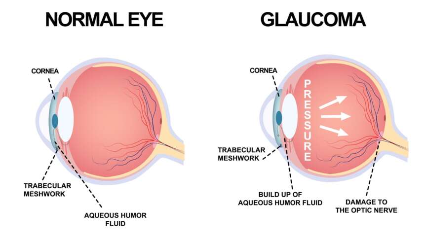Anatomy of an eye defect, glaucoma