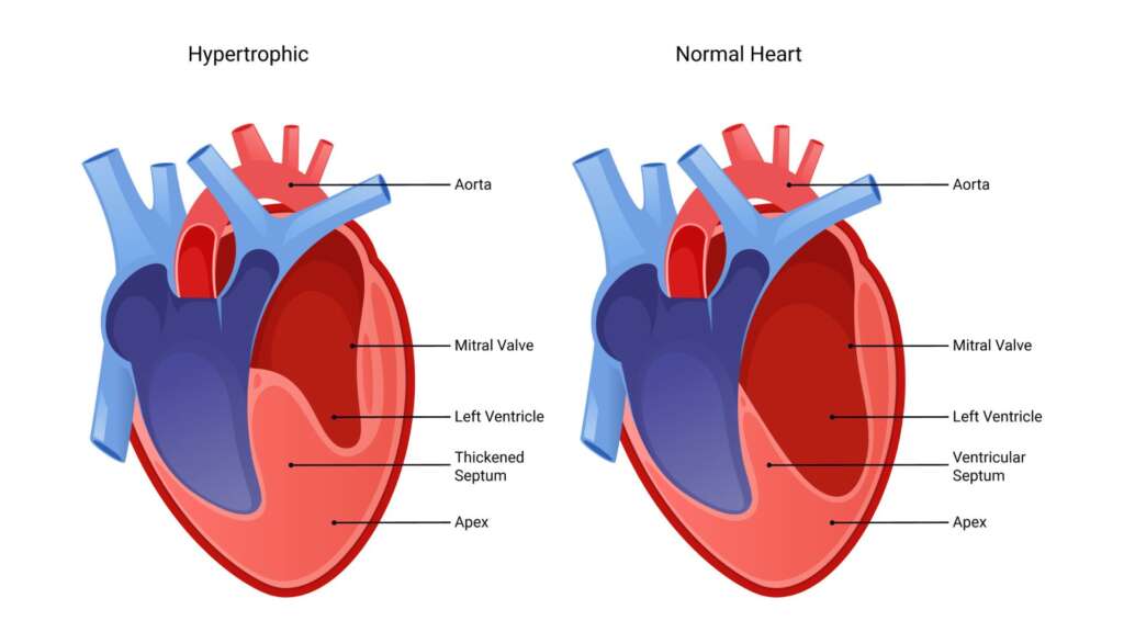 Exploring Cardiomyopathy – Causes, Symptoms, and Treatment
