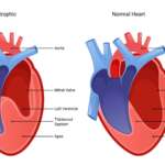 Exploring Cardiomyopathy – Causes, Symptoms, and Treatment