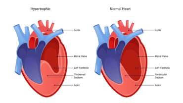 Cardiomyopathy – Causes, Symptoms, Treatment, and Implantable Devices