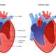 Exploring cardiomyopathy causes, symptoms, treatment, and implantable devices for cardiomyopathy