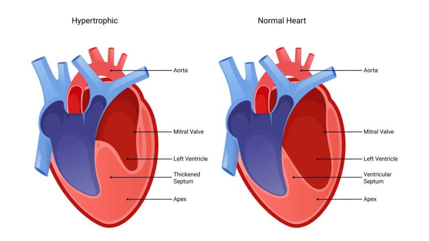 infographic representing cardiomyopathy, a disease of the heart muscle that impairs its ability to pump blood, often leading to heart failure, arrhythmias, and fatigue