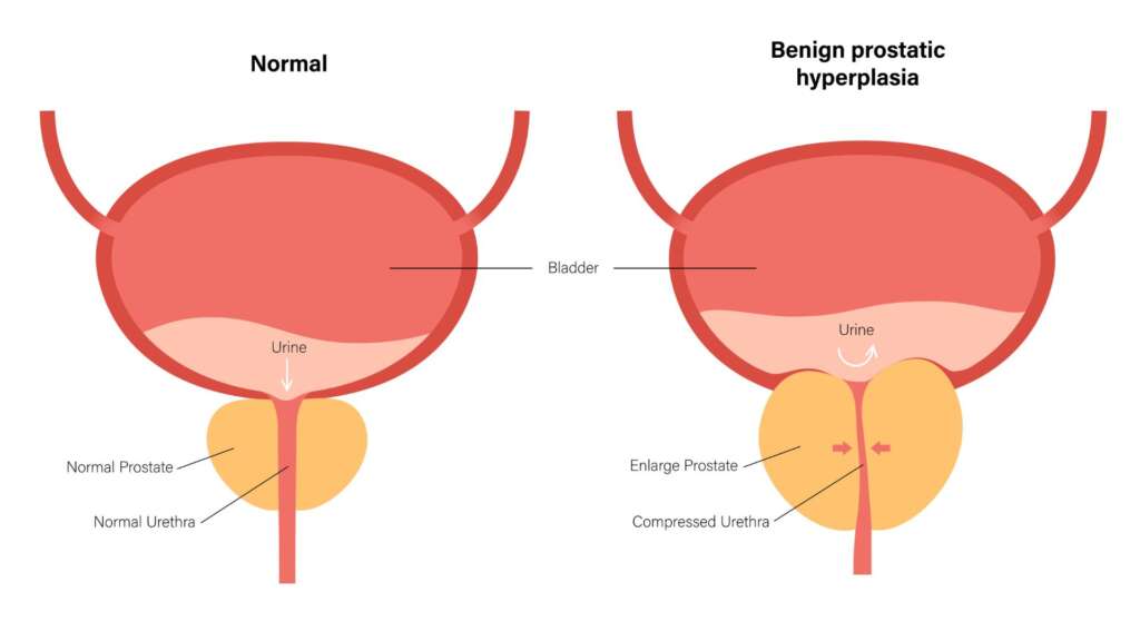 Enlarged Prostate (BPH) – Symptoms, Causes, Treatments, and Surgery Options