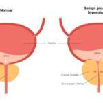 Enlarged Prostate (BPH) – Symptoms, Causes, Treatments, and Surgery Options