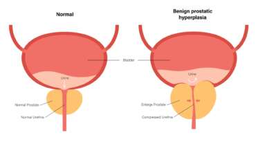 Enlarged Prostate (BPH): Symptoms, Causes, and BPH Treatment Options