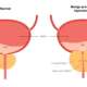 Medical infographic with male enlarged prostate disease problems