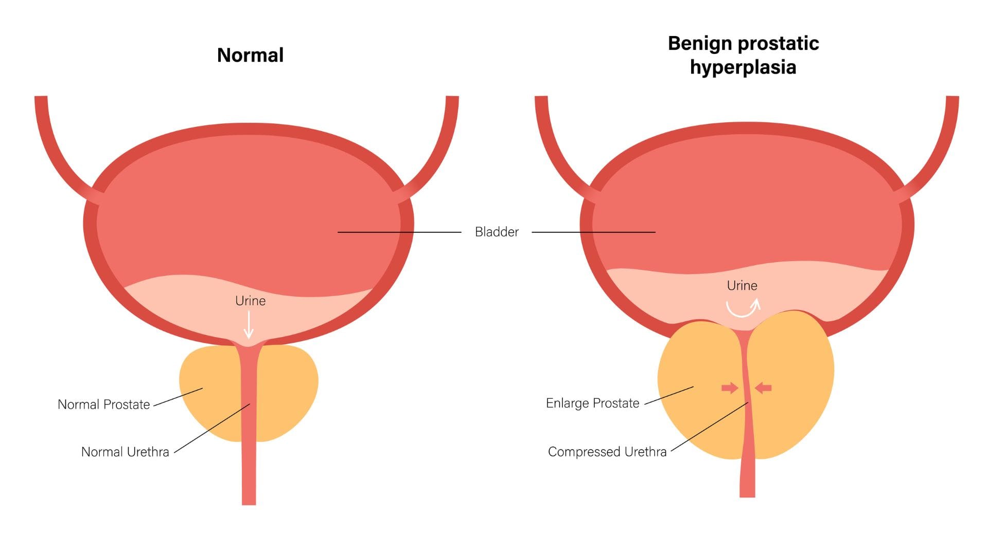 Medical infographic with male enlarged prostate disease problems