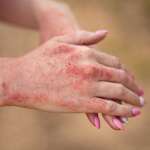 a close-up shot of skin of a patient with atopic dermatitis symptom with of rashes on hand