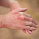a close-up shot of skin of a patient with atopic dermatitis symptom with of rashes on hand