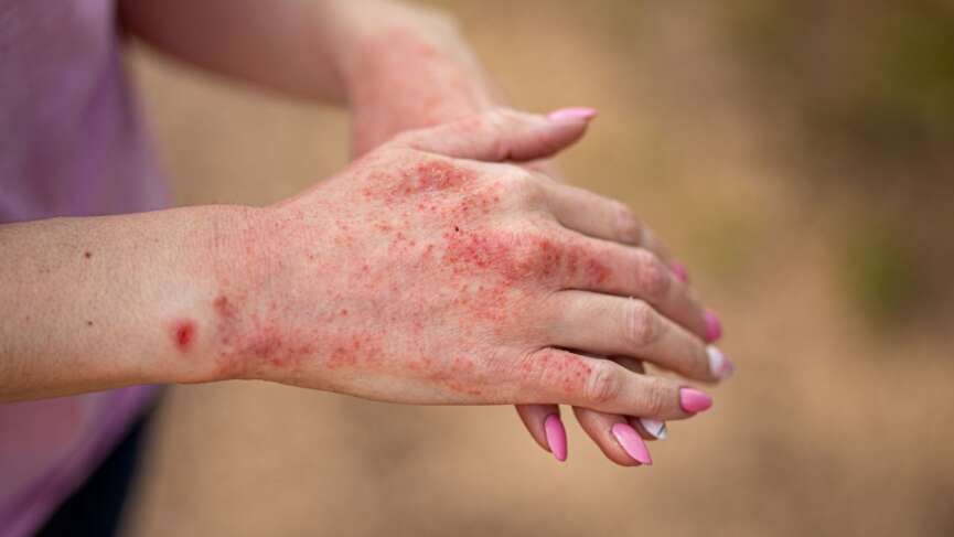 atopic dermatitis