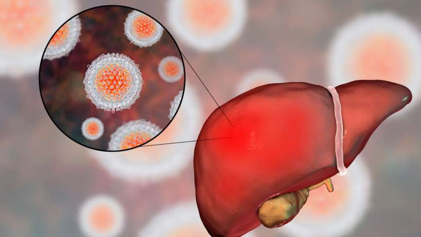 A close-up illustration of liver disease with Hepatitis A and E, which are acute, self-limiting liver infections caused by non-enveloped RNA viruses (HAV and HEV), primarily transmitted via the fecal-oral route through contaminated food or water