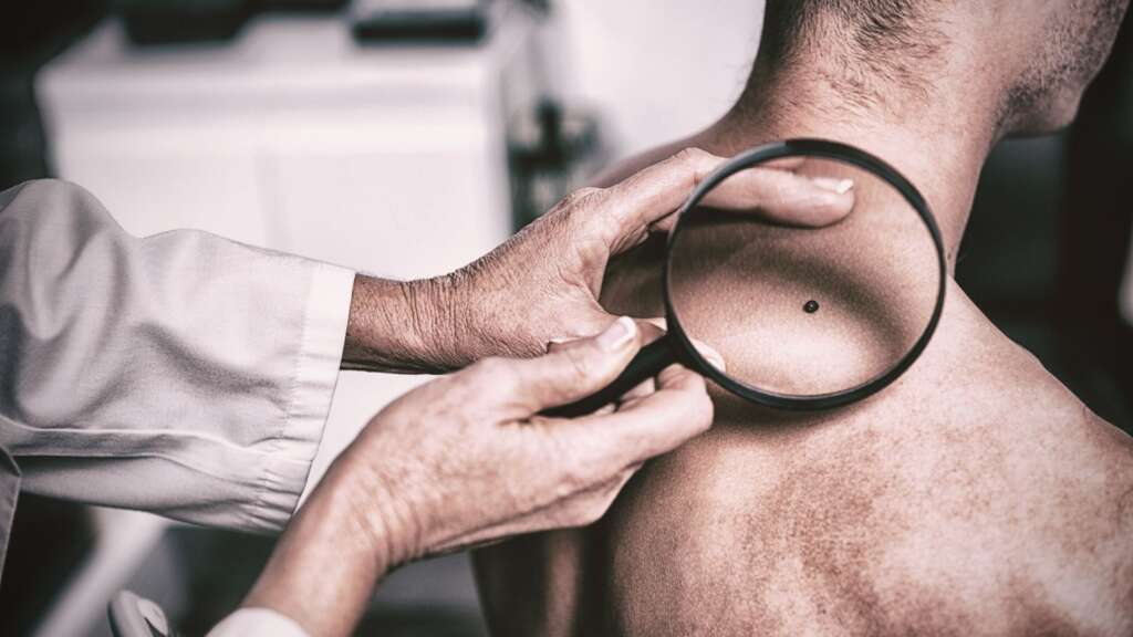Melanoma Explained – Symptoms, Stages, Treatment & Prevention