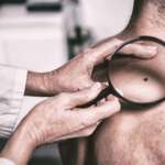 Melanoma Explained – Symptoms, Stages, Treatment & Prevention