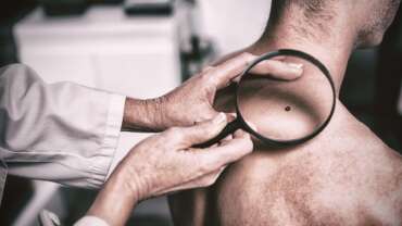 Melanoma Explained – Symptoms, Stages, Treatment & Prevention