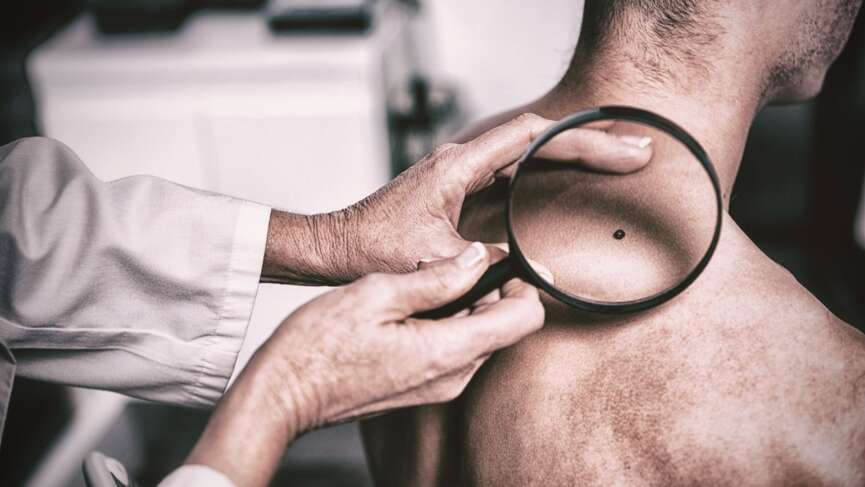 A doctor with a magnifying glass examining the skin tag of a patient with melanoma, which is the most dangerous form of skin cancer, developing from pigment-producing cells (melanocytes) due to UV damage from sun exposure or tanning beds