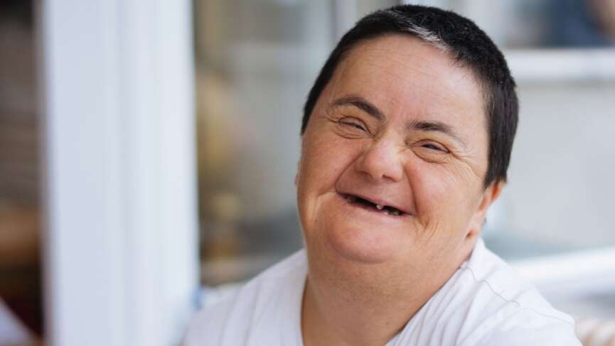 a old women with Cushing's syndrome, which is a hormonal disorder caused by prolonged exposure to high levels of cortisol, often due to long-term high-dose steroid medication use or pituitary/adrenal tumors