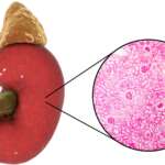 Post-Streptococcal Glomerulonephritis – Causes, Symptoms and Treatment